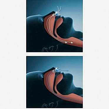 Horlama Önleyici Rahat Uyku Aparatı 